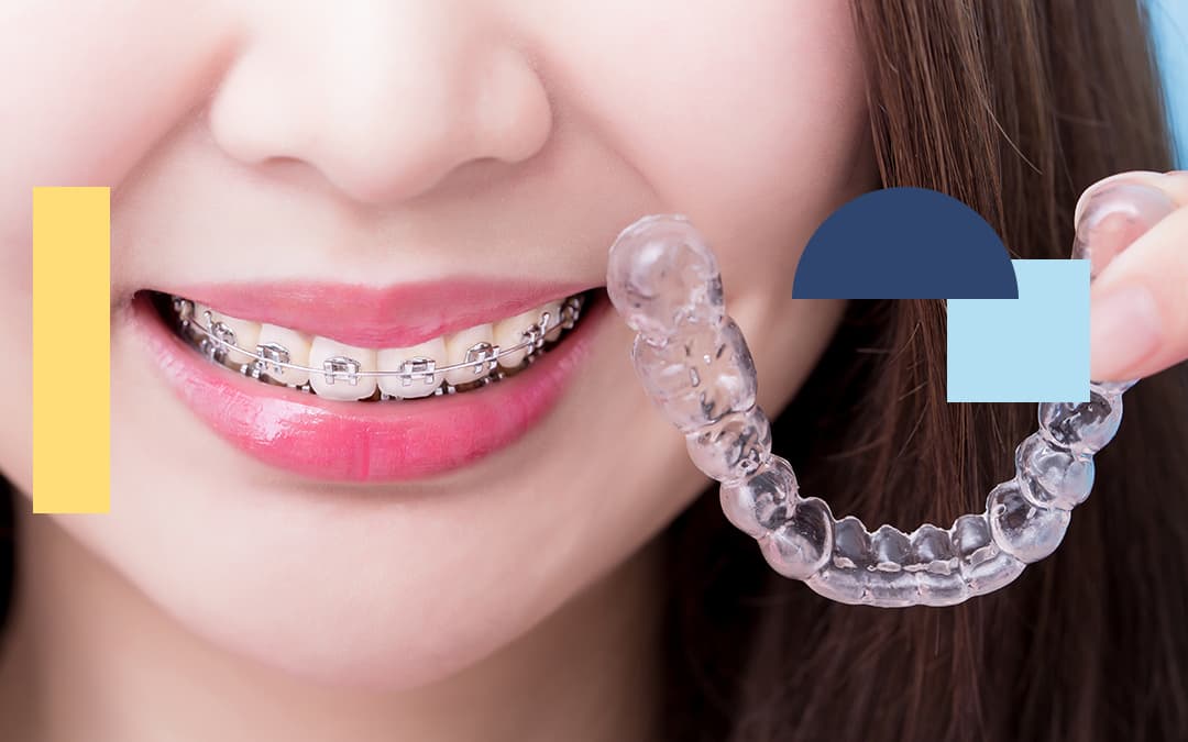 Traditional Metal Braces