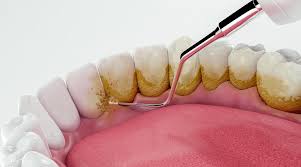 Teeth cleaning (scaling & polishing)